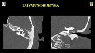 LABYRINTHINE FISTULA
 