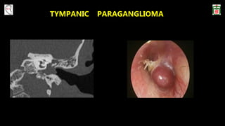 TYMPANIC PARAGANGLIOMA
 