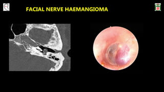 FACIAL NERVE HAEMANGIOMA
 