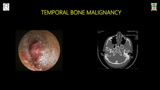 TEMPORAL BONE MALIGNANCY
 