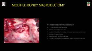 MODIFIED BONDY MASTOIDECTOMY
THE MODIFIED BONDY MASTOIDECTOMY
 A CWD MASTOIDECTOMY PROCEDURE
 REMOVAL OF POSTERIOR CANAL WALL
 INVOLVES EXTERIORIZING THE LATERAL EPITYMPANIC SPACE AND MASTOID CAVITY
 REMOVAL OF CHOLESTEATOMA
 PRESERVATION OF THE OSSICULAR CHAIN
 PLACING A FASCIA GRAFT ONTO THE MEDIAL ASPECT OF THE OSSICULAR CHAIN
 