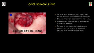 LOWERING FACIAL RIDGE
• THE FACIAL RIDGE IS LOWERED EVENLY USING A LARGE
CUTTING BURR WITH CONTINUOUS SUCTION IRRIGATION.
• DRILLING PARALLEL TO THE COURSE OF THE FACIAL NERVE.
• DIAMOND BURRS - FINAL DRILLING TO THIN THE BONY
COVERAGE OF THE NERVE.
• THE NERVE IS SKELETONIZED BUT NEVER EXPOSED
• INFERIOR CANAL WALL SHOULD BE CONTOURED
SMOOTHLY IN ITS JUNCTION WITH THE CAVITY.
 