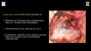 CANAL WALL DOWN (CWD) CAN BE DEFINED AS :
 REMOVAL OF POSTERIOR AND SUPERIOR BONY
WALL OF EXTERNAL EAR CANAL(EAC)
 EXENTERATION OF ALL MASTOID AIR CELLS
 CONVERTING MASTOID CAVITY, MIDDLE EAR AND
EAC INTO A SINGLE CAVITY EXTERIORIZED
THROUGH EAC
 
