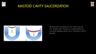 MASTOID CAVITY SAUCERIZATION
BY BEVELING THE EDGES OF THE CAVITY (BLUE),
THE LATERAL SOFT TISSUES (RED) ARE INVITED TO
COLLAPSE INWARD, WHICH ACTS TO REDUCE CAVITY
VOLUME.
 