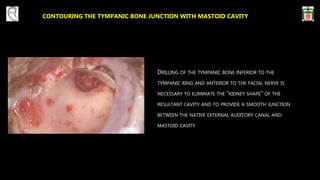CONTOURING THE TYMPANIC BONE JUNCTION WITH MASTOID CAVITY
DRILLING OF THE TYMPANIC BONE INFERIOR TO THE
TYMPANIC RING AND ANTERIOR TO THE FACIAL NERVE IS
NECESSARY TO ELIMINATE THE “KIDNEY SHAPE” OF THE
RESULTANT CAVITY AND TO PROVIDE A SMOOTH JUNCTION
BETWEEN THE NATIVE EXTERNAL AUDITORY CANAL AND
MASTOID CAVITY
 