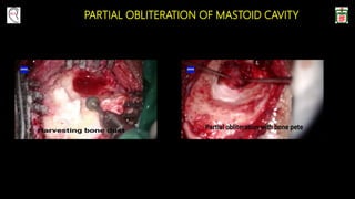 PARTIAL OBLITERATION OF MASTOID CAVITY
 
