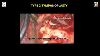 TYPE 2 TYMPANOPLASTY
 