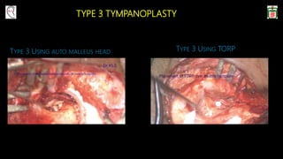 TYPE 3 TYMPANOPLASTY
TYPE 3 USING AUTO MALLEUS HEAD TYPE 3 USING TORP
 