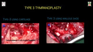 TYPE 3 TYMPANOPLASTY
TYPE-3 USING CARTILAGE TYPE 3 USING MALLEUS SHOE
 