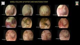 SERIAL FOLLOW-UP AFTER CWD MASTOIDECTOMY
 