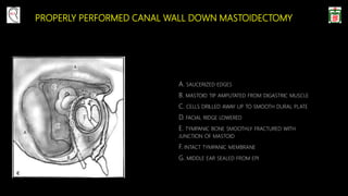 PROPERLY PERFORMED CANAL WALL DOWN MASTOIDECTOMY
A. SAUCERIZED EDGES
B. MASTOID TIP AMPUTATED FROM DIGASTRIC MUSCLE
C. CELLS DRILLED AWAY UP TO SMOOTH DURAL PLATE
D. FACIAL RIDGE LOWERED
E. TYMPANIC BONE SMOOTHLY FRACTURED WITH
JUNCTION OF MASTOID
F. INTACT TYMPANIC MEMBRANE
G. MIDDLE EAR SEALED FROM EPI
F
E
 