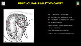 UNFAVOURABLE MASTOID CAVITY
A. THE STEEP NON-SAUCERIZED EDGES
B. THE POTHOLES FROM RESIDUAL AIR CELLS
C. THE INTACT OPEN MASTOID TIP WITH DEBRIS
D. THE HIGH FACIAL RIDGE
E. THE UNCONTOURED TYMPANIC BONE FORMING A
KIDNEY-SHAPED CAVITY
F. TYMPANIC MEMBRANE PERFORATION
G. UNSEALED COMMUNICATION WITH EPITYMPANUM
A
B
C
D
E
F
G
 