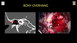 Bony overhang
BONY OVERHANG
 