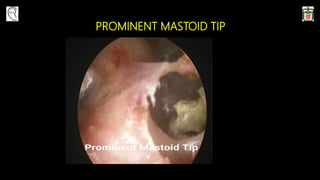 PROMINENT MASTOID TIP
 