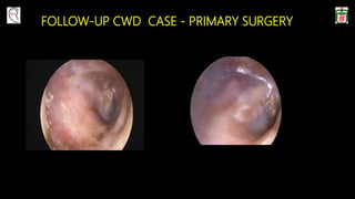 FOLLOW-UP CWD CASE - PRIMARY SURGERY
Pre-op
 