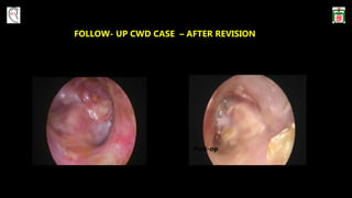 FOLLOW- UP CWD CASE – AFTER REVISION
Post-op
 