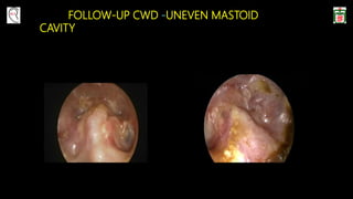 FOLLOW-UP CWD -UNEVEN MASTOID
CAVITY
 