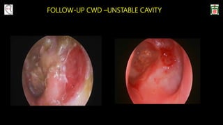 FOLLOW-UP CWD –UNSTABLE CAVITY
 