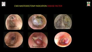 CWD MASTOIDECTOMY INDICATION DISEASE FACTOR
Epitympanic
Cholesteatoma
Mesotympanic
Cholesteatoma
Postsurgical
Cholesteatoma
EAC
Malignancy
Paraganglioma
Facial Nerve
Haemangioma
 