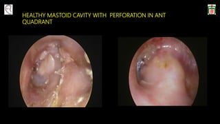 HEALTHY MASTOID CAVITY WITH PERFORATION IN ANT
QUADRANT
 
