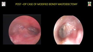 POST –OP CASE OF MODIFIED BONDY MASTOIDECTOMY
 