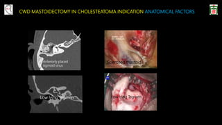 CWD MASTOIDECTOMY IN CHOLESTEATOMA INDICATION ANATOMICAL FACTORS
Low lying Tegmen
Anteriorly placed
sigmoid sinus
Low lying Tegmen
Sclerosed mastoid
 