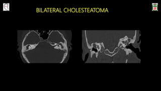 BILATERAL CHOLESTEATOMA
 