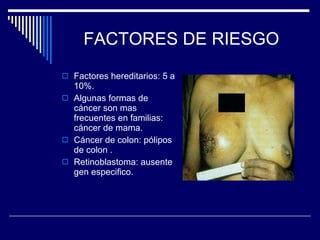 FACTORES DE RIESGO Factores hereditarios: 5 a 10%. Algunas formas de cáncer son mas frecuentes en familias: cáncer de mama. Cáncer de colon: pólipos de colon . Retinoblastoma: ausente gen especifico. 