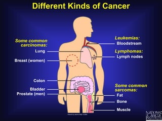Different Kinds of CancerLeukemias:	BloodstreamSome common carcinomas:	LungBreast (women)	ColonBladder	Prostate (men)Lymphomas:	Lymph nodesSome common sarcomas:	Fat	Bone	Muscle