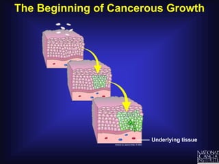The Beginning of Cancerous GrowthUnderlying tissue