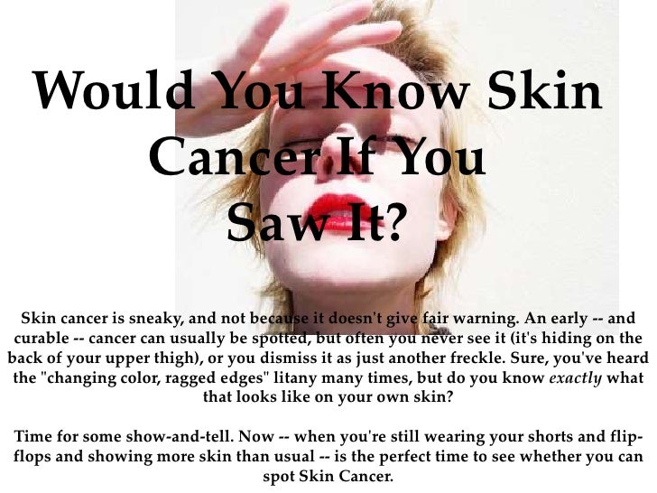 How To Know If You Have A Skin Cancer So You Ve Got Skin Cancer What