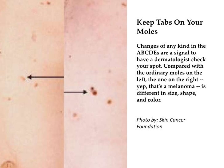 Image Result For Skin Cancer And Skin Of Color Skin Cancer Foundation Image Result For Skin Cancer And Skin Of Color Skin Cancer Foundation
