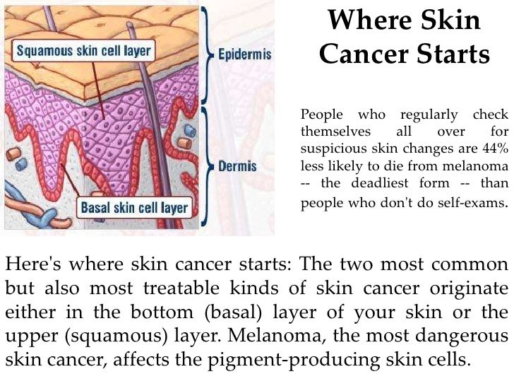 would you know skin cancer if you saw it how do cancer form
