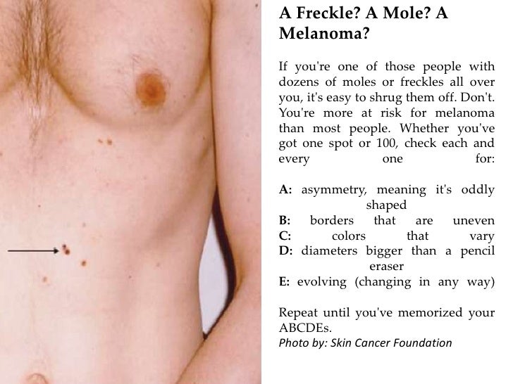 Freckles From Tanning Bed Freckles From Tanning Bed