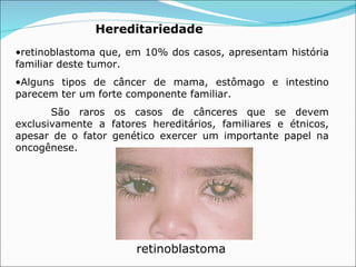 Hereditariedade retinoblastoma que, em 10% dos casos, apresentam história familiar deste tumor. Alguns tipos de câncer de mama, estômago e intestino parecem ter um forte componente familiar.   São raros os casos de cânceres que se devem exclusivamente a fatores hereditários, familiares e étnicos, apesar de o fator genético exercer um importante papel na oncogênese.  retinoblastoma 