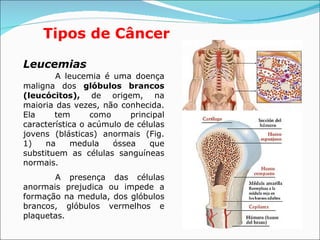 Tipos de Câncer Leucemias A leucemia é uma doença maligna dos  glóbulos brancos (leucócitos) ,  de origem, na maioria das vezes, não conhecida. Ela tem como principal característica o acúmulo de células jovens (blásticas) anormais (Fig. 1) na medula óssea que substituem as células sanguíneas normais. A presença das células anormais prejudica ou impede a formação na medula, dos glóbulos brancos, glóbulos vermelhos e plaquetas.  