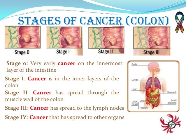 Alimentos que producen cancer de colon