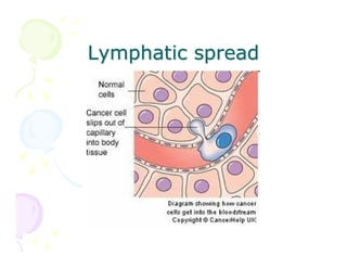 Lymphatic spread

 