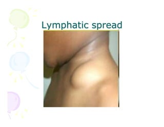 Lymphatic spread

 