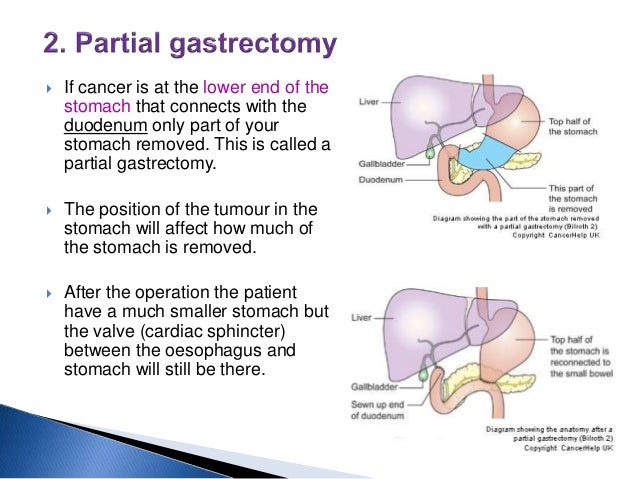 Gastrectomy Diet Advice From Dna