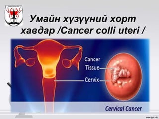 Умайн хүзүүний хорт
хавдар /Cancer colli uteri /
 