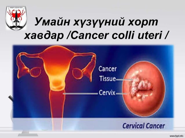 умайн хүзүүний хорт хавдар | PPT