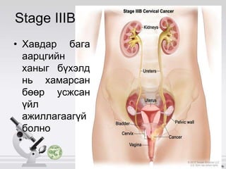Stage IIIB
• Хавдар бага
аарцгийн
ханыг бүхэлд
нь хамарсан
бөөр усжсан
үйл
ажиллагаагүй
болно
 