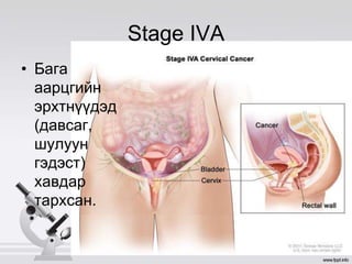 Stage IVA
• Бага
аарцгийн
эрхтнүүдэд
(давсаг,
шулуун
гэдэст)
хавдар
тархсан.
 