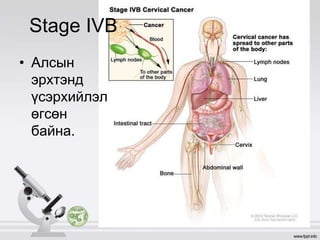 Stage IVB
• Алсын
эрхтэнд
үсэрхийлэл
өгсөн
байна.
 