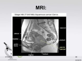MRI:
1/11/2016 55
 
