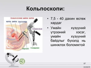 Кольпоскопи:
• 7,5 - 40 дахин өсгөж
хардаг
• Умайн хүзүүний
үтрээний хэсэг,
умайн хүзүүний
байдлыг бүхэлд нь
шинжлэх боломжтой
57
 