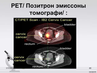 PET/ Позитрон эмиссоны
томографи/ :
1/11/2016 65
 