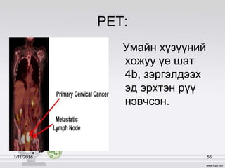 PET:
Умайн хүзүүний
хожуу үе шат
4b, зэргэлдээх
эд эрхтэн рүү
нэвчсэн.
1/11/2016 66
 