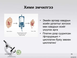 Хими эмчилгээ
• Эмийн аргаар хавдрын
эсийн ургалтыг зогсоох
мөн хавдрын эсийг
үхүүлэх арга
• Платин дээр суурилсан
/фторурацил +
цисплатин буюу зөвхөн
цисплатин/
1/11/2016 76
 